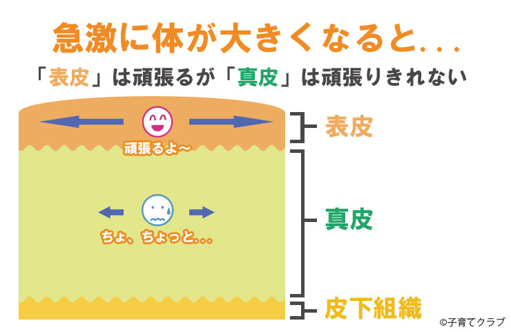 妊娠線ができるメカニズム